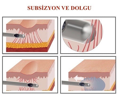 Dr. Bülent Bağcı Subsizyon ve Dolgu